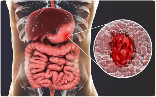 Stomach Cancer : કોલોન કેન્સરને આ લક્ષણોથી ઓળખો, જાણો ગેસ્ટ્રિક કેન્સરનું કારણ