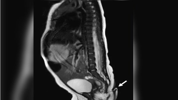 ડોક્ટરોએ સર્જરી કરી પૂંછડી હટાવી