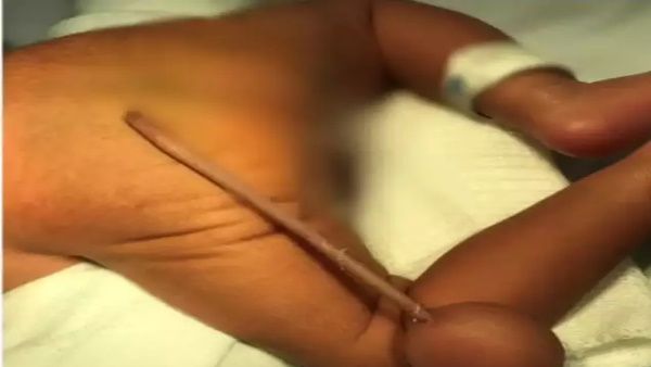 બ્રાઝિલમાં પણ 12 સેમી પૂંછડી સાથે બાળક જન્મ્યુ હતુ