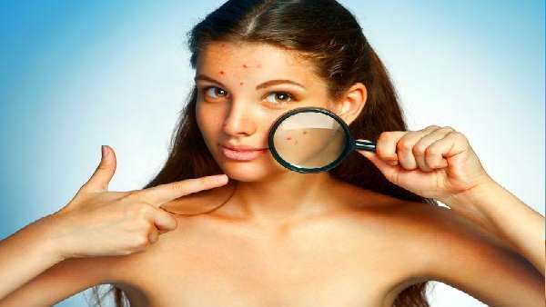 ખીલ અને ડાઘાને કરે દૂર