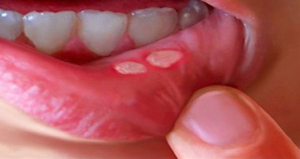 મોઢાના ચાંદામાંથી મળે છે રાહત