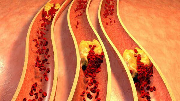 એલડીએલ (Low-Density Lipoprotein) :