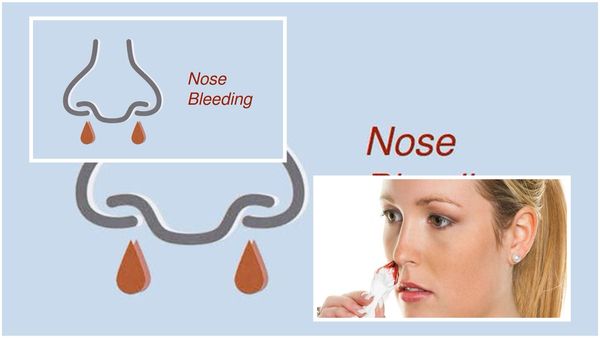 Nose Bleeding : નસકોરી ફુટવાની સમસ્યાથી છો પરેશાન, આ રીતે તાત્કાલિક મળશે આરામ