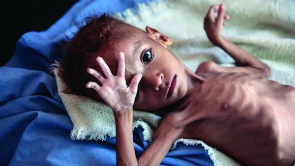 ગુજરાતમાં કુપોષણના લીધે ત્રમ મહિનામાં 2447 નવજાત બાળકો અને 156 માતાના મૌત