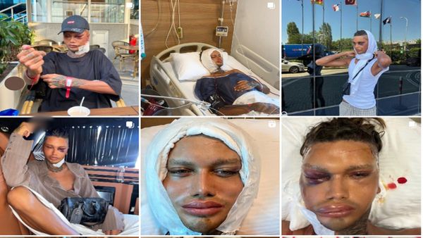 કંટાળો દૂર કરવા આ છોકરો કરાવે છે ફેસિયલ સર્જરી, 15 વાર બદલ્યો ચહેરો