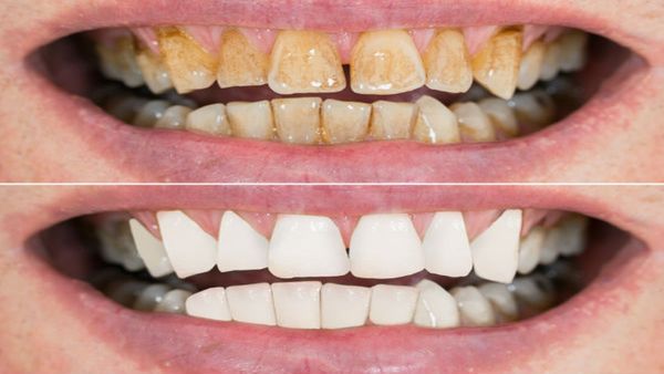 oral health tips : મોતી જેમ ચમકશે દાંત, આ ટિપ્સથી દાંતની પીળાશ થશે દૂર