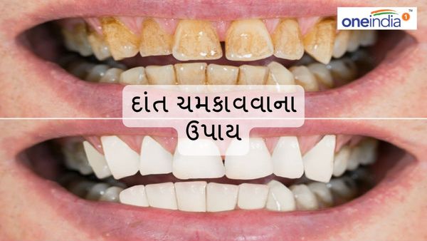 Whiten teeth Remedy : મોતી જેવા થઇ જશે દાંત, કરી લો આ પાંચ ઉપાય