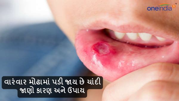 Health Tips: વારંવાર મોઢામાં પડી જાય છે ચાંદી, જાણો કારણ અને ઉપાય