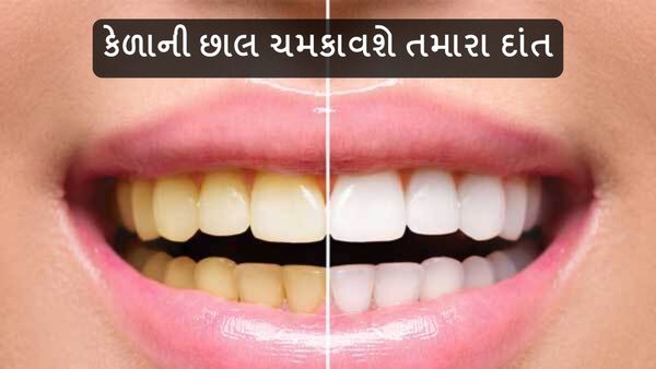 Teeth White Remedy: કેળાની છાલ ચમકાવશે તમારા દાંત, જાણી લો આ ઉપાય