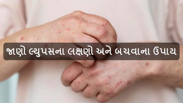 what is lupus is Gujarati: સ્ત્રીઓને વધુ અસર કરી શકે છે લ્યુપસ, જાણો લક્ષણો અને બચવાના ઉપાય
