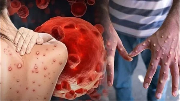 Monkeypox in India: ભારતમાં મંકીપૉક્સના પહેલા કેસની પુષ્ટિ, સરકારે જાહેર કરી એડવાઈઝરી, આ રીતે રહો સુરક્ષિત