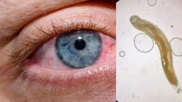 નોનવેજ ખાનારા થઈ જજો સાવધાન ! દર્દીની આંખમાંથી એક ઈંચ લાંબો કીડો નીકળતા ડૉક્ટરો હેરાન