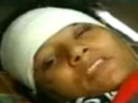 अपाहिज एथलीट अरुणिमा का दोबारा काटा गया पैर