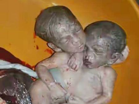 बिहार में दो सिर वाले बच्चे का जन्म