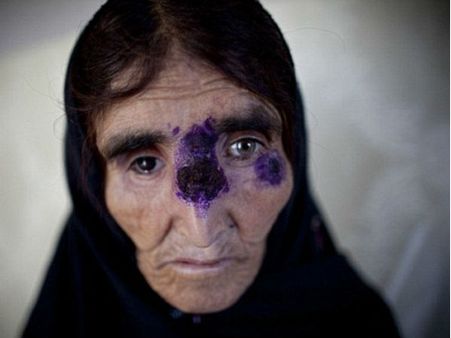 सीरिया से यूरोप और सऊदी अरब की ओर बढ़ी इबोला जैसी खतरनाक बीमारी