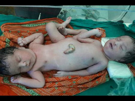 बिहार के बक्सर में जन्मा दो सिर वाला अदभुत बच्चा, 4 हाथ पर 2 पैर