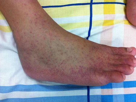 चिकनगुनिया ने किया दिल्‍ली को बीमार, 8 साल का टूटा रिकॉर्ड