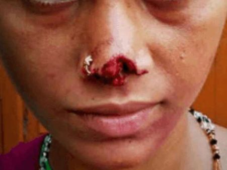 शाहजहांपुर: झगड़ा हुआ तो पति ने दांतों से पत्नी की नाक को काट डाला