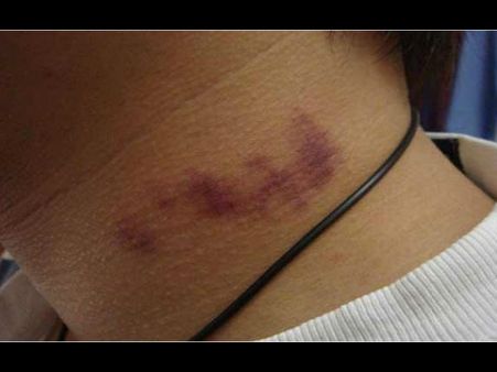 गर्लफ्रेंड ने दी लव बाइट और हो गई लड़के की मौत