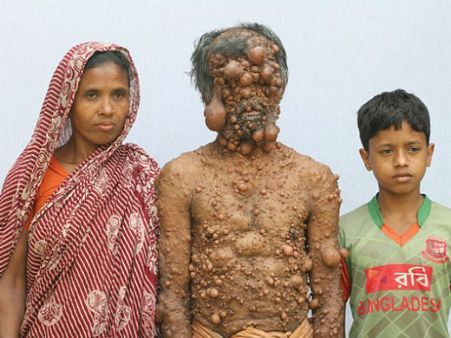 OMG! डरावने ट्यूमर, राक्षस समझ भाग जाते हैं लोग