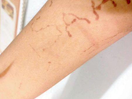 नई-नवेली दुल्हन को सिगरेट से जलाता था पति, सास-ससुर ने भी किया उत्पीड़न