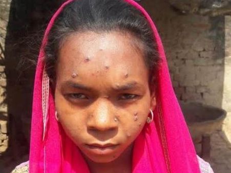 य़ूपी: बहराइच में तेजी से फैली महामारी, 22 बच्चे बीमार, 6 की हालत नाजुक