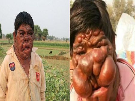 बिहार: खौफनाक चेहरे के साथ जी रहा है ये लड़का, देखकर हर कोई फेर लेता है मुंह