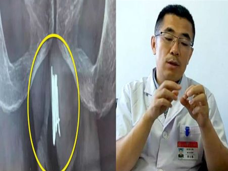 अपने ही प्राइवेट पार्ट में लगा लीं 15 सुई, उसके बाद की कहानी खुद ही पढ़ लीजिए