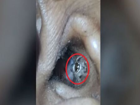 महिला के कान से निकली जिंदा मकड़ी, खौफनाक VIDEO देखकर सिहर जाएंगे आप