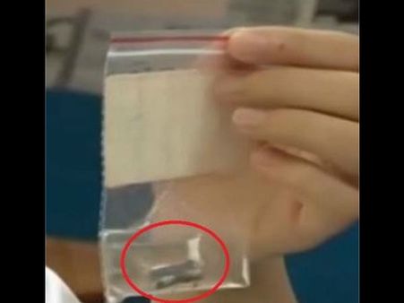 कान में हुआ तेज दर्द, अंदर जिंदा छिपकली को देखकर उड़ गए होश