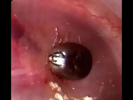 कान के भीतर घुसा कीड़ा चबा रहा था मांस और फिर...