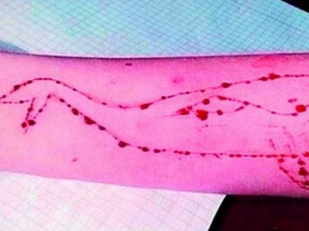 मध्य प्रदेश: ब्लू व्हेल गेम में लड़की ने 25 बार काटा अपना हाथ फिर छत से कूदी, डॉक्टर को लगाने पड़े 100 टांके