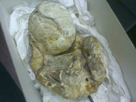 नागपुर में एक महिला के पेट से 15 साल पुराना भ्रूण निकाला