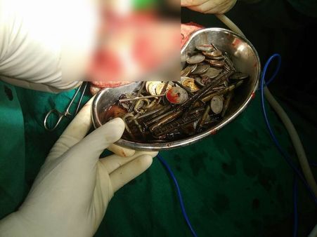 युवक को लोहा निगलने का शौक पड़ा भारी, पेट से निकले 2 हजार के सिक्के