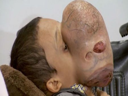 चेहरे पर फुटबॉल जैसा ट्यूमर लेकर हुआ था पैदा, सर्जरी के बाद हुई मौत