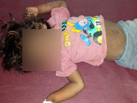 बहराइच: खसरे से सगी बहनों समेत तीन मासूमों की मौत, 25 से अधिक बीमार