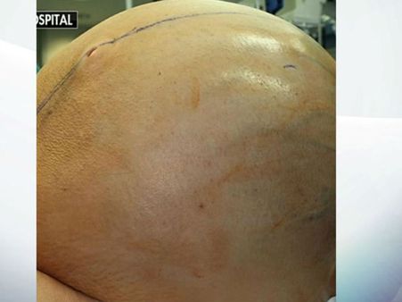 महिला के पेट से निकला 60 किलो का ट्यूमर, 12 डॉक्टरों ने किया ऑपरेशन