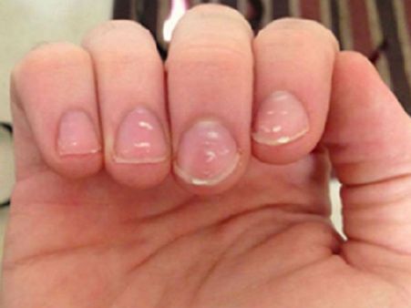 गौर से देखिए... क्या आपके नाखूनों पर भी है ऐसा निशान