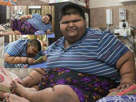 दुनिया के सबसे वजनी बच्चे का दिल्ली में हुआ ऑपरेशन, 14 साल की उम्र में वजन 273 किलोग्राम