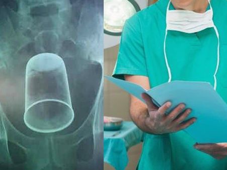 पेट में हो रहा था दर्द, एक्स-रे कराने पर निकला स्टील का ग्लास