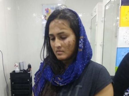 शादी से पहले ब्‍यूटी पार्लर गई दुल्‍हन, झुलसा गया चेहरा