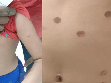 क्रूर मां ने शरारत करने पर बच्ची को दी दिल दहलाने वाली सजा, मोमबत्ती से दागा शरीर