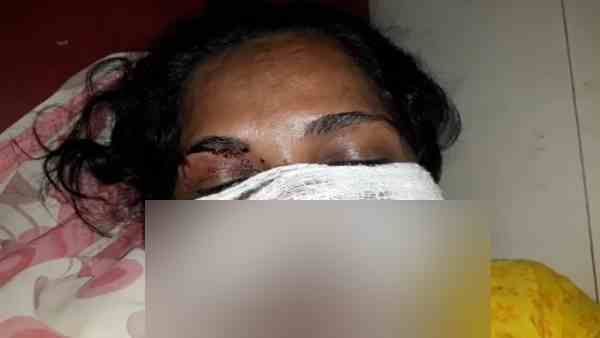 पत्नी ने इस काम के लिए रोका तो पति ने पहले पीटा फिर दांत से नाक काटकर हो गया फरार