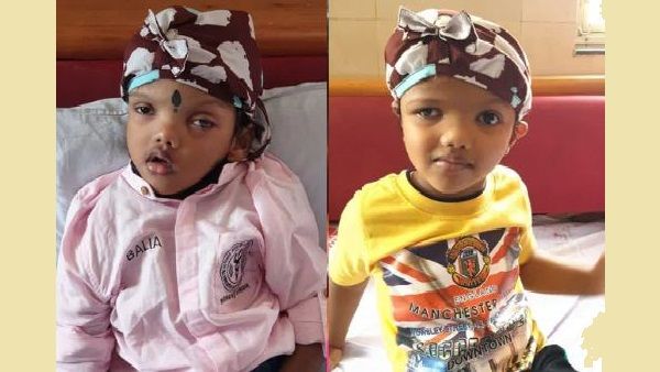 सिर से जुड़े जग्गा और बलिया को 125 डॉक्टरों की टीम ने सर्जरी के जरिए किया अलग, एम्स में हुआ ऐसा पहली बार