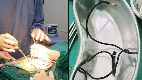 शख्स ने मूत्राशय में डाल लिया चार्जर का केबल, डॉक्टरों ने ऑपरेशन कर निकाला एक मीटर लंबा तार