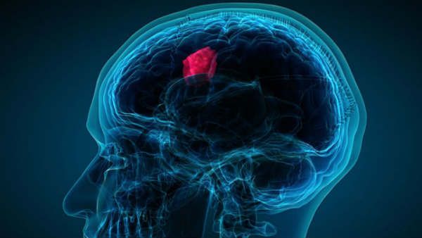 World Brain Tumour Day 2020: जानिए कितना खतरनाक होता है ब्रेन ट्यूमर, क्‍या हैं इसके लक्षण और उपाय