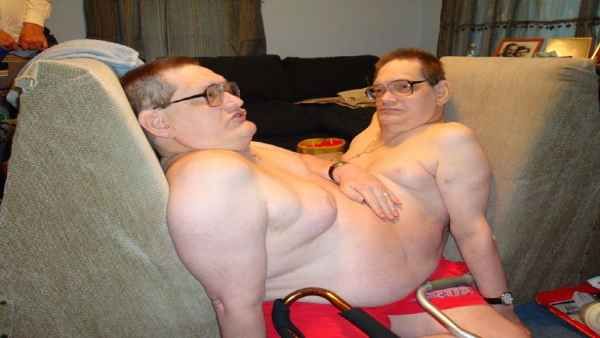 एक ही शरीर से जुड़े दुनिया के सबसे उम्रदराज जुड़वा भाइयों की हुई मौत, जानें कैसे बीता इनका जीवन