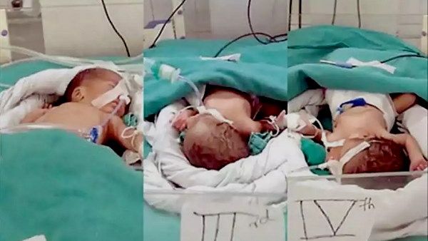 गुजरात: महिला ने दिया एक साथ 3 बेटियों को जन्म, डॉक्टरों ने 15 दिन तक की देखरेख, फिर दी छुट्टी