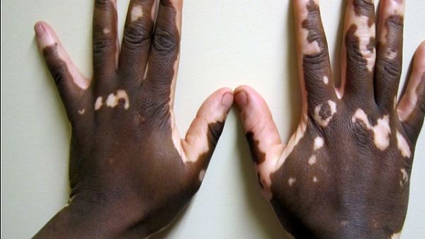 त्वचा पर सफेद दाग देता है कमजोर बुध, सूर्य-मंगल-शुक्र भी बनते हैं कारण