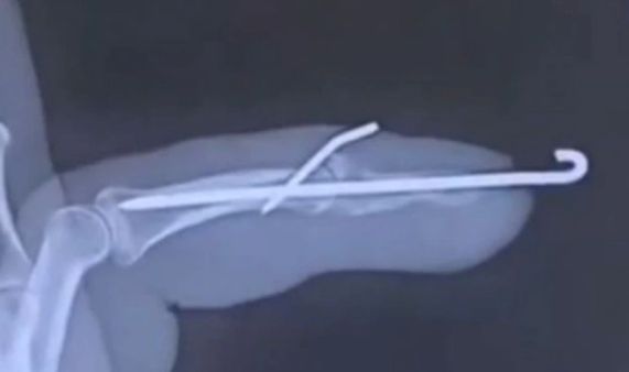 गंभीर चोट के बाद शख्स ने शेयर किया एक्स-रे का फोटो, सोशल मीडिया पर यूजर खुजलाने लगे सिर